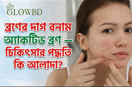 ব্রণের দাগ ও অ্যাকটিভ ব্রণ আলাদা চিকিৎসা
